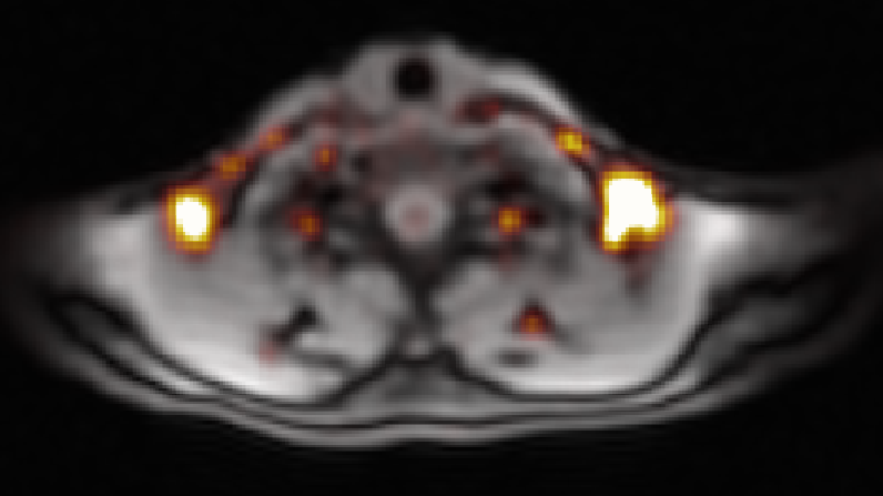 bodymapdigital's tweet photo. #BatMap Brown adipose tissue #BAT by #MRI. Burning hot 🔥 in the upper chest 👉 metabolic health ✅ https://t.co/pTMKUMu7X1
