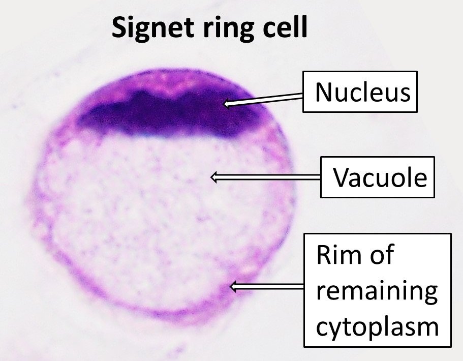 📙HISTOPATHOLOGY MCQs 📝Signet ring 💍 cells are seen in which of the following malignancy ❓ A) Carcinoma Cervix B) Carcinoma Endometrium C) Krukenberg Tumor D) Carcinoma Vulva #medx #medEd