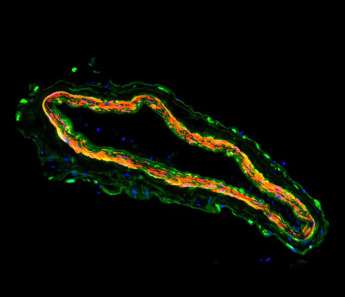 🌟 Huge congrats to Raquel Alsina Planelles of @UBneuroscience @UniBarcelona for clinching the runner-up spot with 'Exploring an Artery of the Human Hippocampus'! 👏 Big thanks to everyone involved in the contest