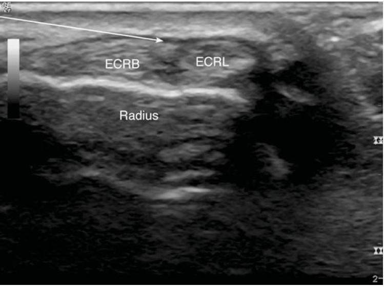 We’ve updated our page on the 2nd dorsal compartment injection for ECRB and ECRL tenosynovitis. Be sure to check it out! wikism.org/Second_Dorsal_… #sportsmed #sportsmedicine #ebm #medicine #sports #foamSM #MedEd #FOAMed #ortho #medtwitter #OrthoTwitter