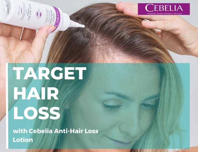 Cebelia’s Anti-Hair Loss Lotion is formulated to stimulate hair growth, reduce hair loss by strengthening the hair follicle and improving anchorage. This daily leave-in treatment contains patented CEBELINE peptide, Niacinamide &amp; Pichia Minuta. #Cebelia #hairgoals #thinninghair