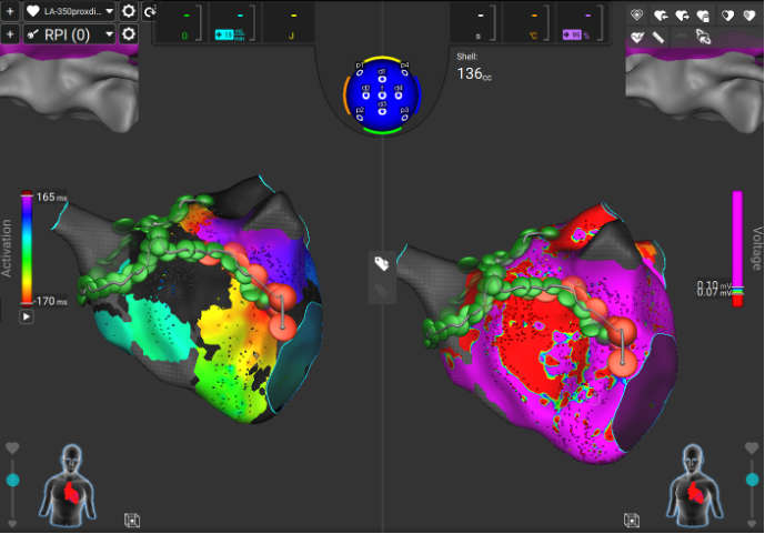 VictorCastroUrd's tweet photo. Seamless first experience with Sphere 9 catheter and Affera for re-do ablation of AF and perimitral flutter! ⚡️AML+PWI + RSPV+CTI line, all with FPI. Positive sensations from mixed RF and PFA point-by-point ablation. @al_aloro @DocNanoG @ifdezlozano @JorgeToquero @UseGarIzq https://t.co/8UN5drQ253