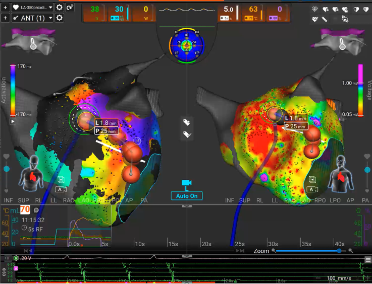 VictorCastroUrd's tweet photo. Seamless first experience with Sphere 9 catheter and Affera for re-do ablation of AF and perimitral flutter! ⚡️AML+PWI + RSPV+CTI line, all with FPI. Positive sensations from mixed RF and PFA point-by-point ablation. @al_aloro @DocNanoG @ifdezlozano @JorgeToquero @UseGarIzq https://t.co/8UN5drQ253