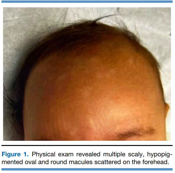 5 month old with hypopigmented macules that developed after a visit to the beach. Dx: Tinea Versicolor Culprit: Malassezia Exceptionally rare under 1 year of age! #neoTwitter #dermtwitter pubmed.ncbi.nlm.nih.gov/38237888/