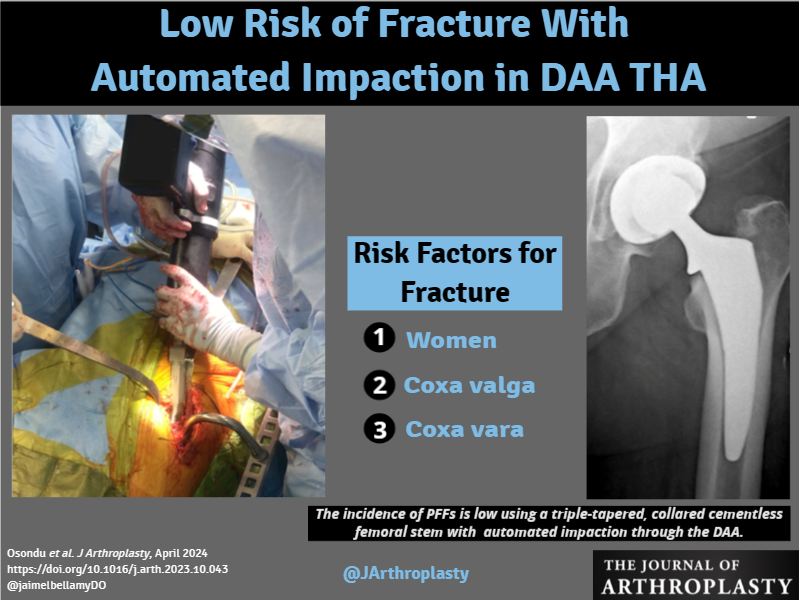 The incidence of PFFs is low using a triple-tapered, collared cementless femoral stem with automated impaction through the DAA THA. arthroplastyjournal.org/article/S0883-…