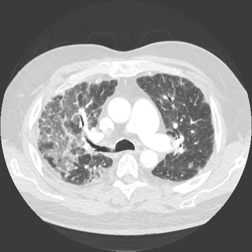 60 yo M with VEXAS syndrome s/p allogeneic BMT was diagnosed with COVID-19. Treated with Paxlovid. 
Presented a month later with progressive dyspnea. CT scan below. 
Bronchoscopy with BAL was negative. No prior history of GVHD. Not on any new meds. 

What is Your Diagnosis?