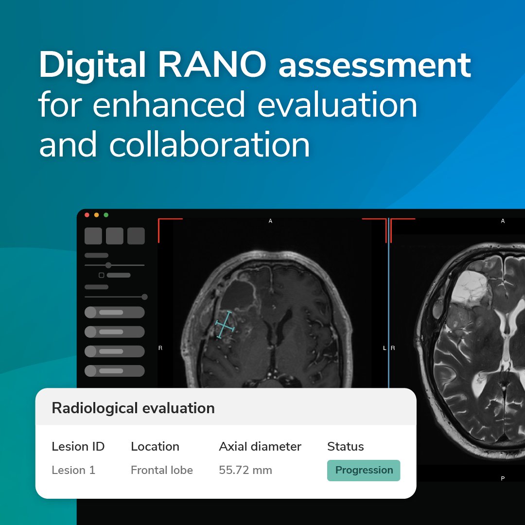 Advancing #GlioblastomaAssessments with #DigitalRANO 💻🧠 Improve your neuro-oncology clinical trial with our Digital RANO tool: a streamlined, user-friendly platform for efficient data management and simplified evaluations. Learn more:bit.ly/4aEbYXR