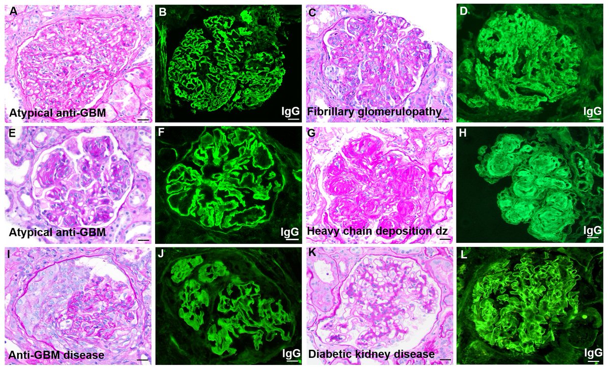 Our comment includes a wonderful pic by @Tiff_Caza from @arkanalabs showing morphologic mimics of 'atypical' anti-GBM! @AKronbichler @AJKDonline ajkd.org/article/S0272-…