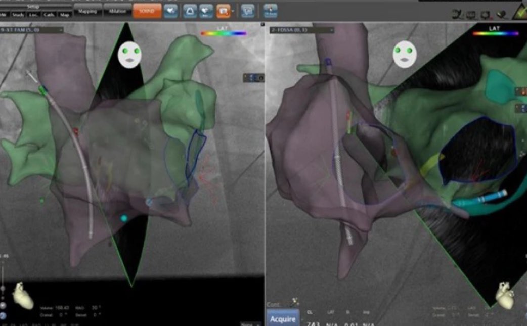 New editorial in @JICE_EP by Matthew Singleton and @josoriomd Intracardiac echocardiography, electroanatomical mapping, and the obsolescence of fluoroscopy for catheter ablation procedures rdcu.be/dEder #EPeeps