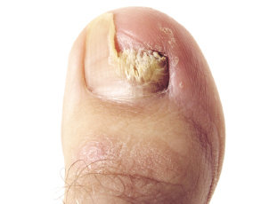 elzorrotacneno's tweet image. Un dato.
Examinas tus uñas, especialmente las de los pies, ahora fíjate en la uña de tu pulgar, el dedo gordo.
¿Tiene una especie de hongo?
Si lo tienes ya comenzó a afectación hepática y hay que tratar inmediatamente.