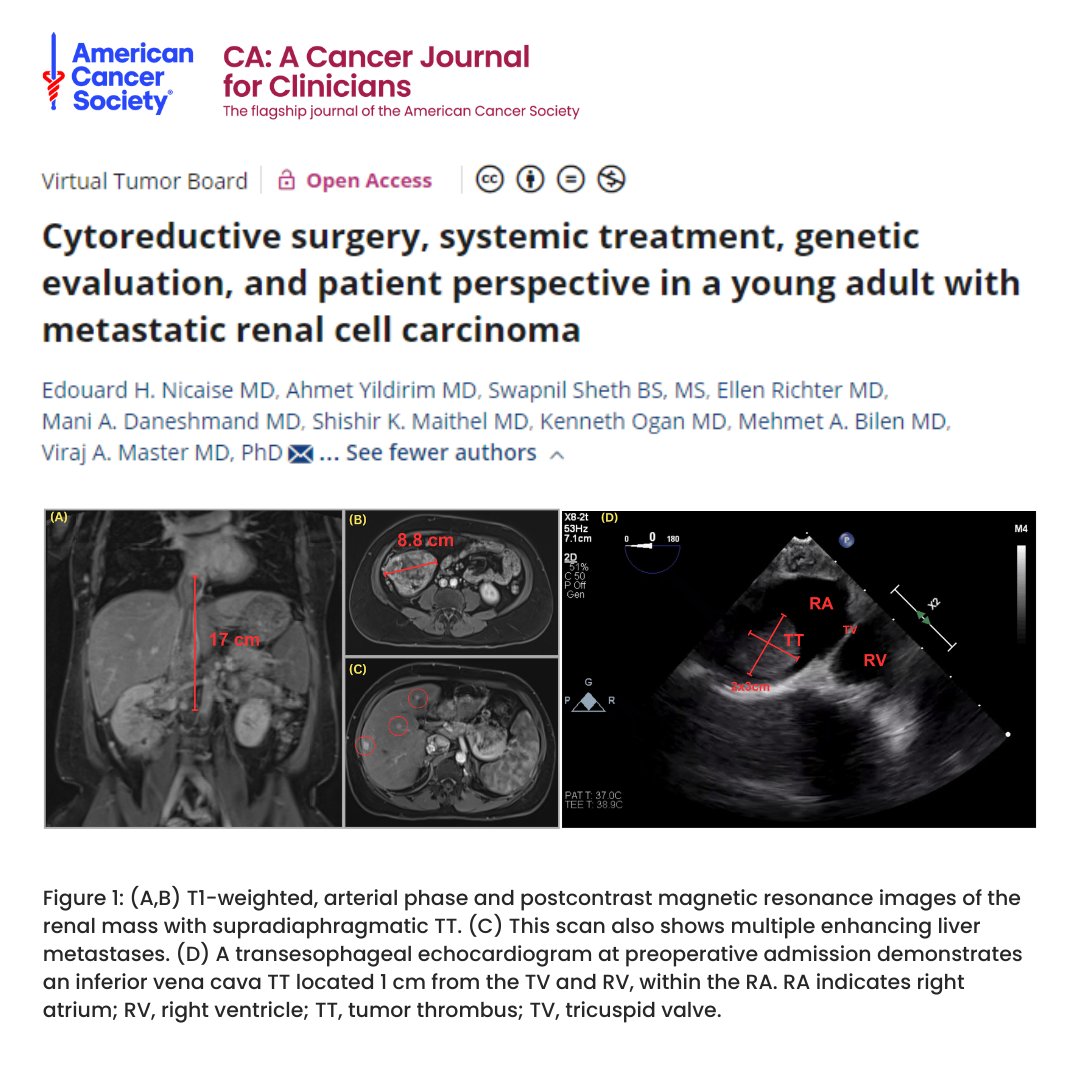 New #VirtualTumorBoard | Experts from @WinshipAtEmory treat a young adult with metastatic #RenalCellCarcinoma and offer cytoreductive surgery, systemic treatment, genetic evaluation, and patient perspective in this unique case. acsjournals.onlinelibrary.wiley.com/doi/10.3322/ca… #TumorBoardTuesday #AACR24