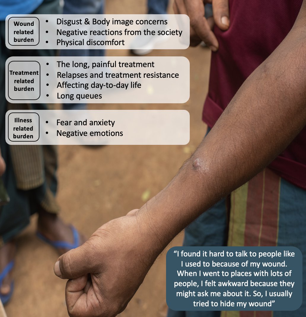 Did you know that #WeAreECLIPSE researchers conceptualised the #psychosocialburden of #CutaneousLeishmaniasis in Sri Lanka? This was crucial for grasping the true burden of CL and developing interventions to reduce it. @NIHRglobal @PLOSNTDs Read more --> doi.org/10.1371/journa…