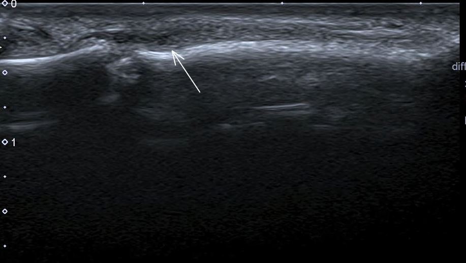 themskarchive's tweet photo. @pepelermarx @JM_Zulueta_O @drwillyjara @DmcRadiologia @ESSRmsk @SermeMsk DIAGNOSIS - 3⃣Extensor tendon mechanism lesion. In this patient a distal central slip non-osseous avulsion of the extensor tendon was diagnosed. See the correlation between physical examination - XRAY and US. #finger #traumatwitter #MSK https://t.co/yKk2glmYqd