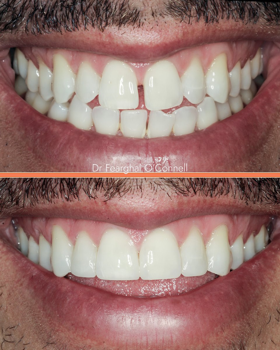 Turning frowns into stunning smiles, one gap at a time! 🌟 Witness the incredible work of Dr Fearghal O'Connell at 3Dental - crafting a full, straight and harmonious transformation that could be your reality too! 🦷😁 #SmileTransformation #HappyPatient