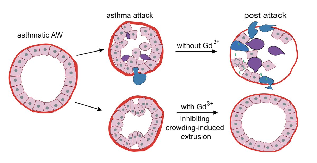 Why are current therapies to treat #asthma not always effective? Crowding-induced cell extrusion causes epithelial damage and #inflammation. In mice, #gadolinium blocks extrusion and prevents inflammation & mucus secretion. @RosenblattLab @kingsmedicine ow.ly/yyLE50RaxjL