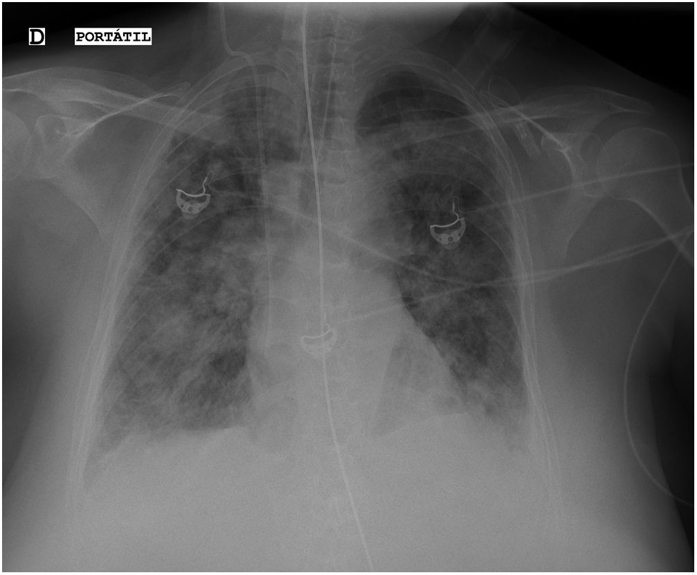 🫁 Hoy te mostramos cómo la ecografía pulmonar desvela claves en el SDRA para comprender y tratar de manera más efectiva la enfermedad. ➡️ Accede a la última imagen clínica publicada en la revista #ArchivosdeBronconeumología 🔗 n9.cl/l31g2 #SDRA