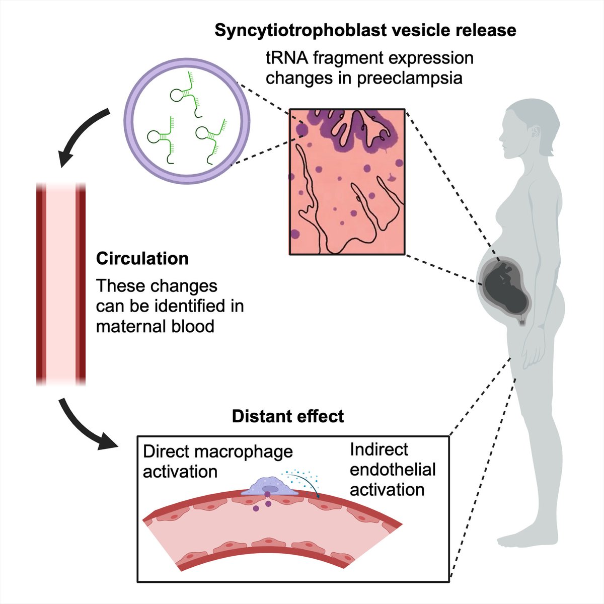 tRNA fragments, novel vesicle-bound small RNAs released into maternal blood by the placenta, drive inflammation in preeclampsia @DrWillCooke @Ox_wrh @UniofOxford @CUHKMedicine @WellcomeTrust ahajournals.org/doi/10.1161/HY…