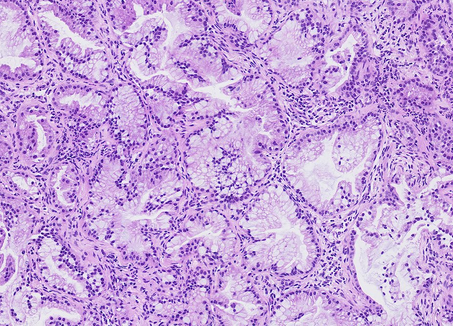 🫁💦🔗🔬 💟 Cyto-histo morphology correlation between #BAL Bronchoalveolar lavage fluid #cytology and #cryobiopsy . Diagnosis was mucinous adenocarcinoma of lung in a never smoker patient. #cytopath #pulmpath