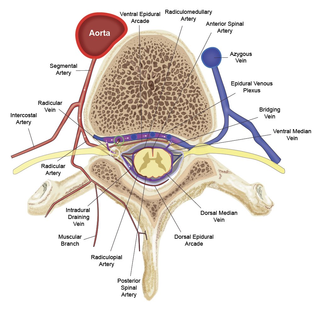 How do you approach spinal EPIdural fistulas? @charlesbeaman et al. of @UCLAHealth: These rare lesions may be adequately treated by endovascular embolization with their series of 26 cases. 69% demonstrate early improved clinical outcomes. New pub alert 🚨 bit.ly/3xw2fEP