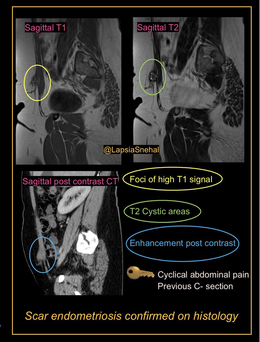 Lovely example of classic case where clinical history is vital. #FOAMrad #FOAMed #meded #radres #futureradres #medstudenttwitter #gitwitter #anatomy #frcr #surgery #radiology #radtwitter #medtwitter #obgyn