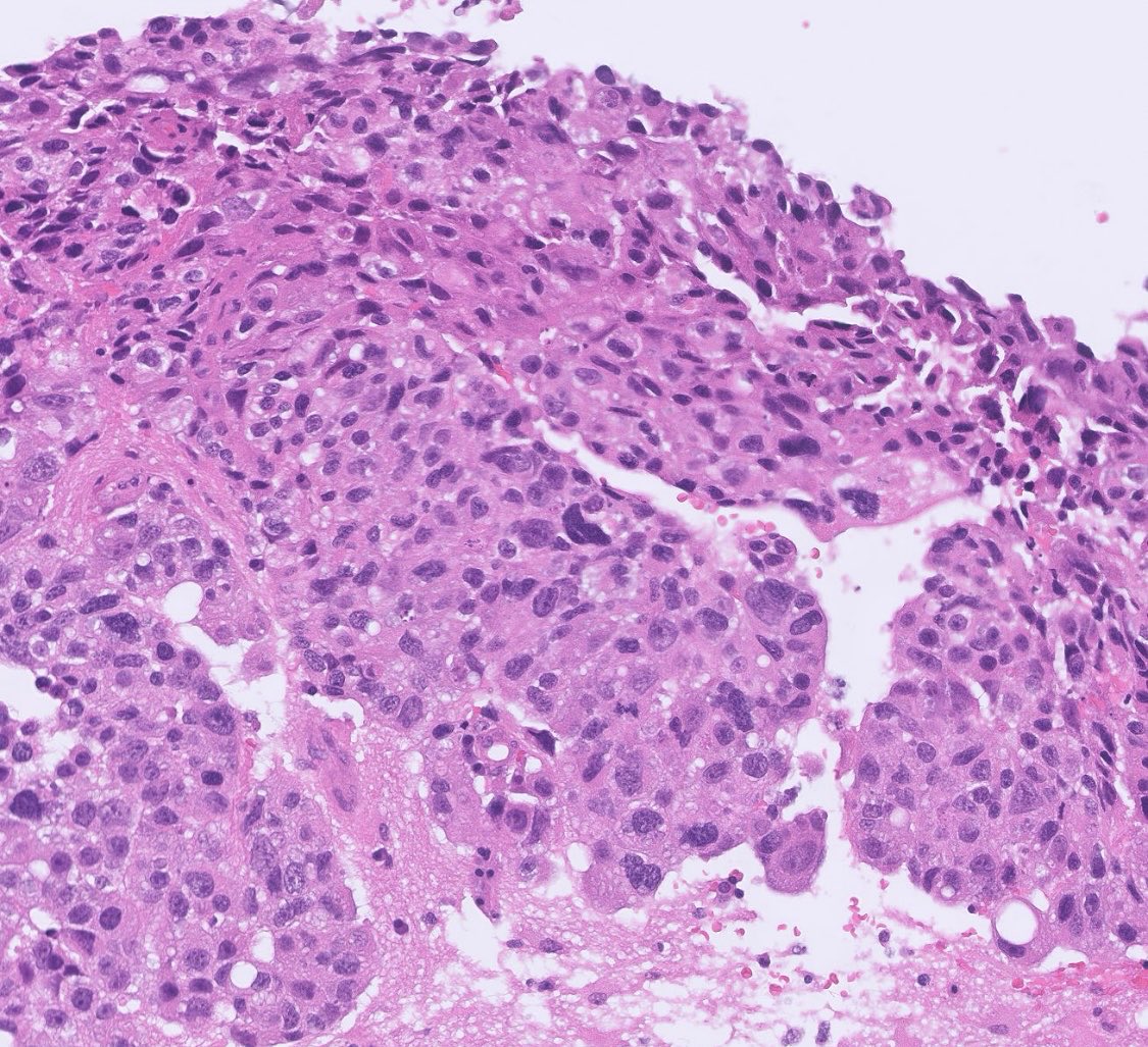 PeterKobalka's tweet image. Probably the ugliest met prostate adenocarcinoma to brain I’ve seen. Fun fact: prostate strongly prefers the meninges and only very rarely gets in the brain. #neuropath #cnspath #neuropathology #pathtwitter #pathx