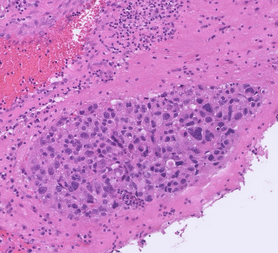 Probably the ugliest met prostate adenocarcinoma to brain I’ve seen. Fun fact: prostate strongly prefers the meninges and only very rarely gets in the brain. #neuropath #cnspath #neuropathology #pathtwitter #pathx