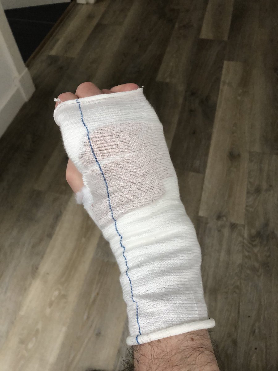 Discharged from hospital 21/03/24 after 5 mths, which was after 4 mths stuck in Apt. Next day off to Scotland to stay with family. <48hrs later burnt myself with a kettle, had to attend Minor Injuries Unit.🙄 Needs re-dressed every 3 days, at least it’s making sure I rest up.🙄