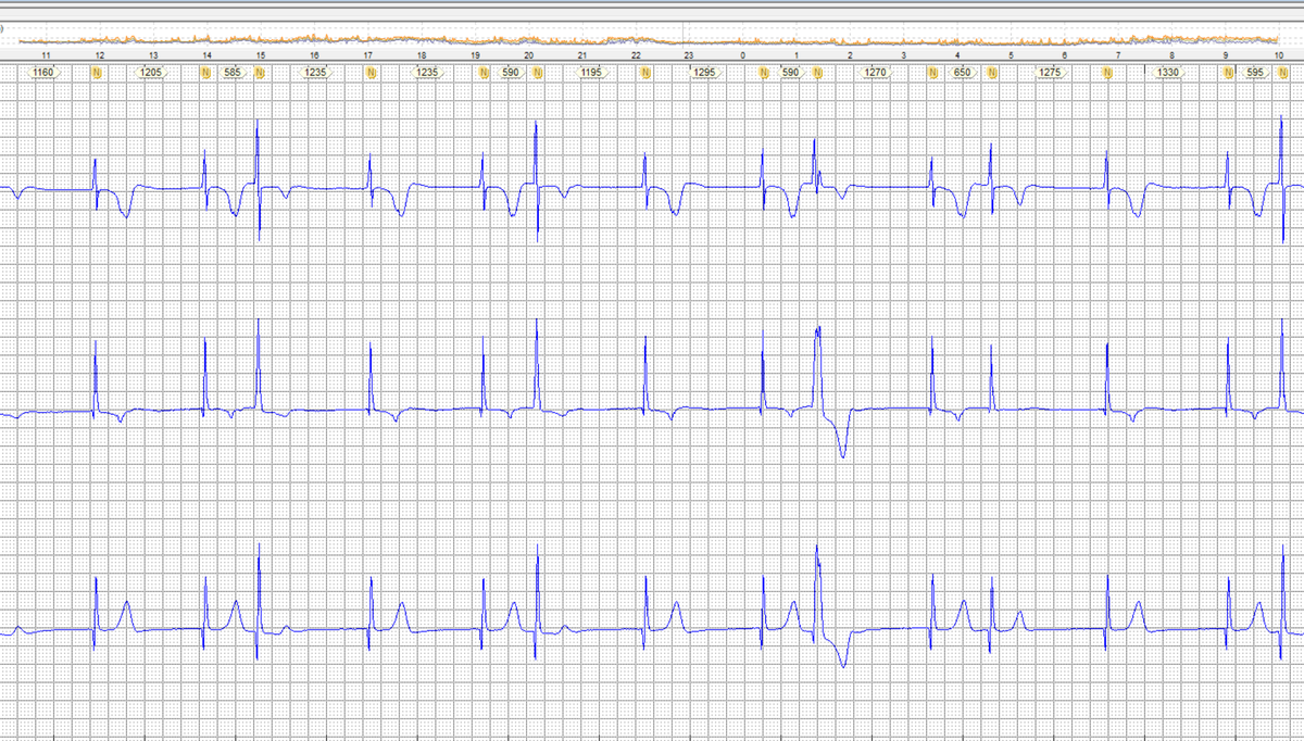 Nice Holter strip @The_Nanashi_O @EcgOxford @ecgrhythms @ecgandrhythmRoe @SergioPinski @DidlakeDW @lucasmouraeef