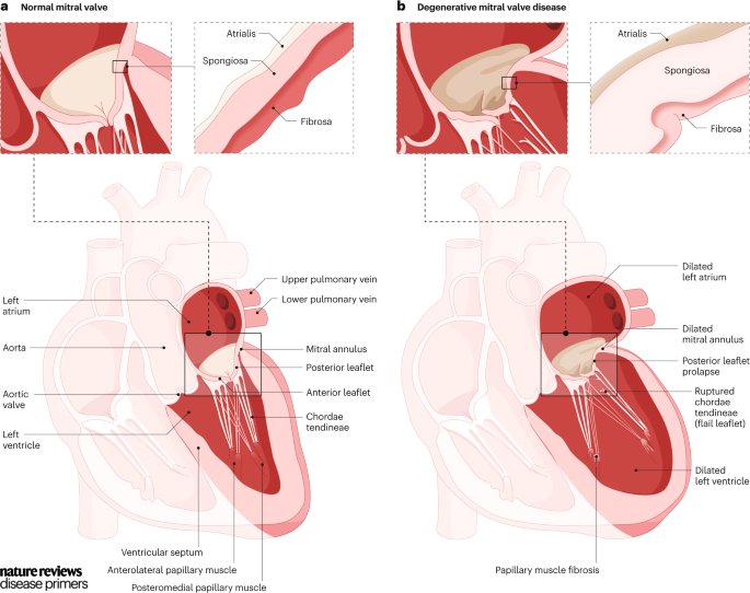 In degenerative mitral valve disease, the prolapsing scallop of the posterior mitral leaflet shows significant growth of the spongiosa layer. #MitralRegurgitation go.nature.com/4aaHPjy