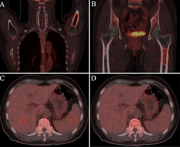'Assessment of diffuse bone marrow involvement on 18F-fluoro-D-glucose PET/computed tomography.' Zhang T., Wang L., Yang F., Wang H. & Ping Li P. rdcu.be/dEf2Z link.springer.com/article/10.100…