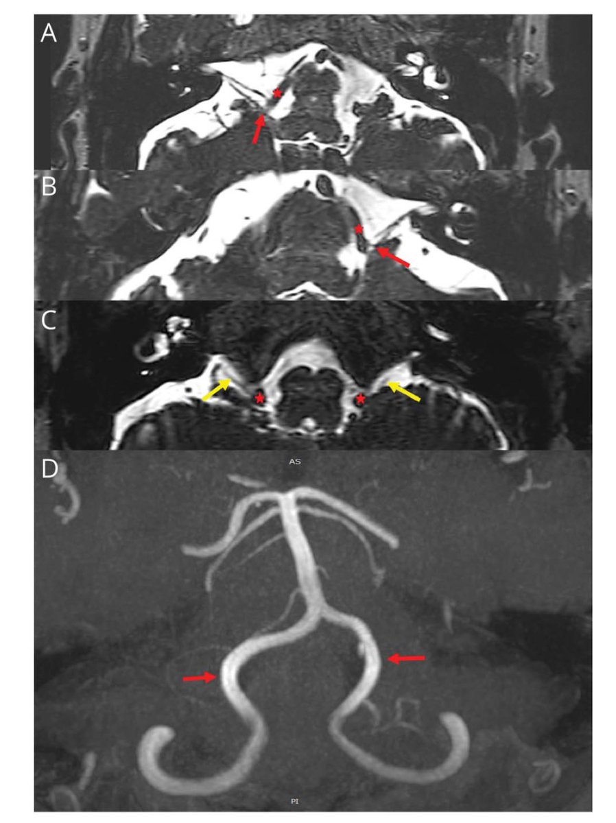 Bilateral Hemifacial Spasm and Left Glossopharyngeal Neuralgia Caused by Bilateral Vertebral Artery Displacement neurology.org/doi/pdf/10.121…