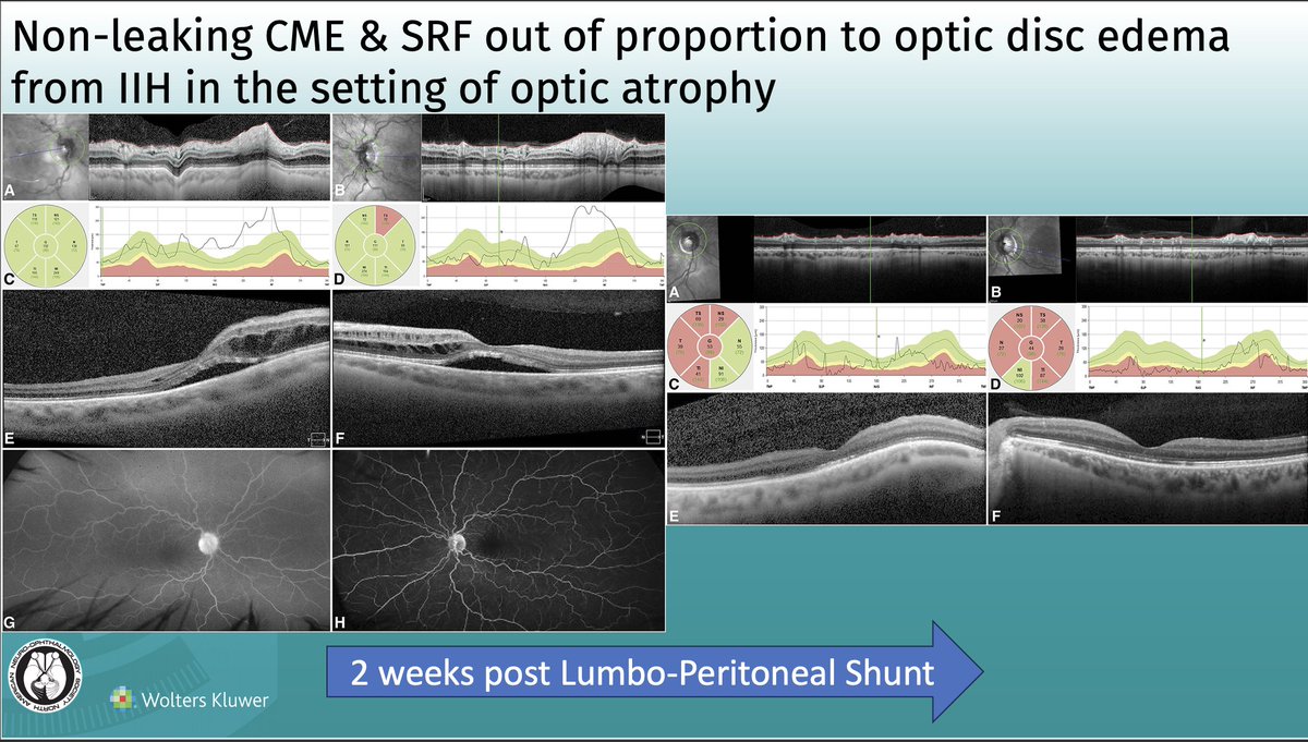 Recurrent Increased ICP Presenting as Macular Edema in the Setting of Optic Atrophy: JNO
Article: bit.ly/JNO_papilledem…
 #brain #eye #vision #research #NeuroTwitter #NeuroOphth #EyeTwitter #MedTwitter #IIH #Migraine #papilledema #macula #retina @HennepinHC @umnmedschool