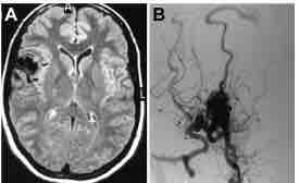 #JNSCaseLessons: An illustrative case of recurrence of arteriovenous malformation in an adult patient after complete resection thejns.org/caselessons/vi…