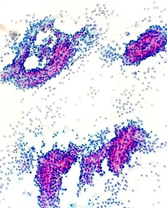 Fine needle aspiration of a mass in the tail of the pancreas reveals monotonous tumor cells that are loosely cohesive and lining capillary sized blood vessels. What is the diagnosis? buff.ly/3YOFX97 #PathArt #CytoPath #PathTwitter #MedTwitter