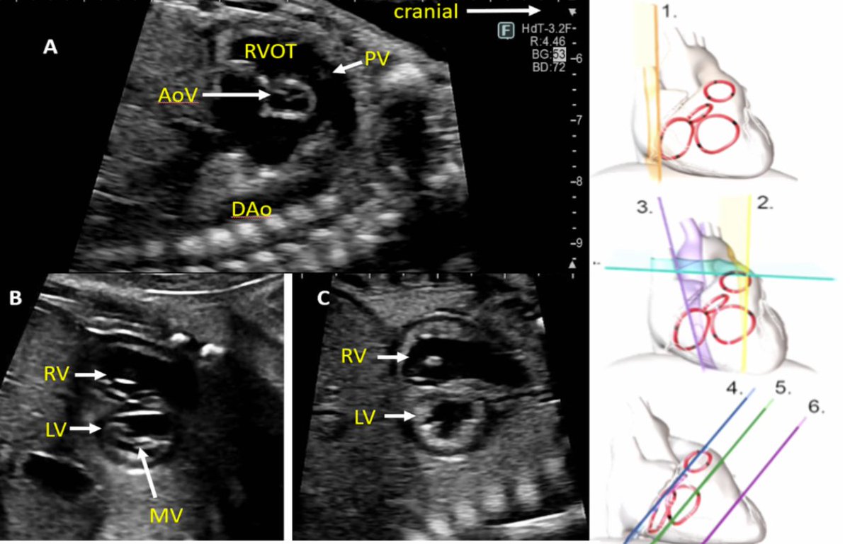 Industry Sponsored Message: Dive into the updated Fetal Echocardiography Guidelines with @moon_grady, MD! 🫀 @Fujifilm Healthcare Americas is pleased to sponsor this educational webinar. This webinar is available in the ASE Learning Hub. bit.ly/3PU59tj