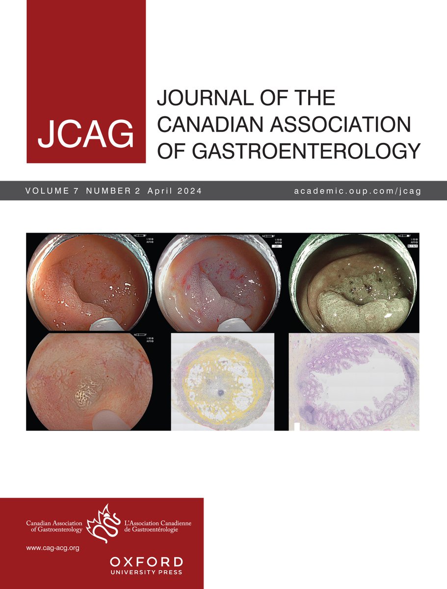 The new issue of @JCanAssnGastro! academic.oup.com/jcag/issue/7/2 Highlights of the issue include: - Details of @CanGastroAssn new Climate Change Committee - Scoping review on patient and public involvement in IBD research - Measuring the impact of patient engagement from @IMAGINE_SPOR