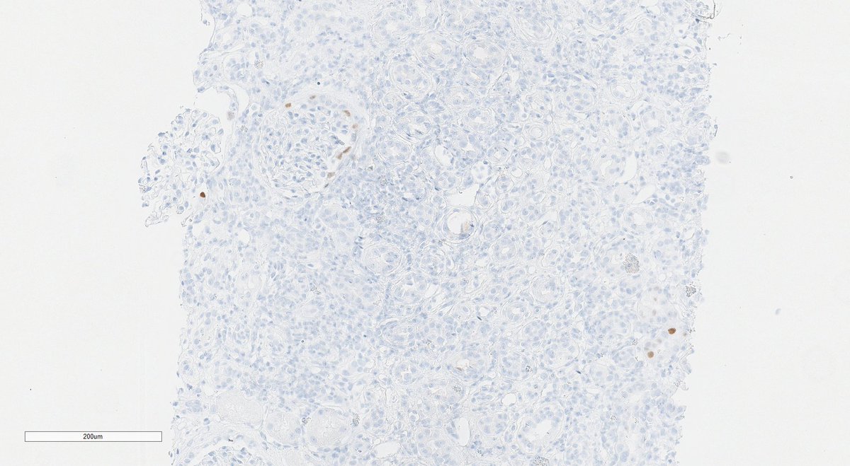 Native kidney biopsy in bone marrow transplant patient for worsening renal failure. Bx shows severe tubulointerstitial nephritis. Not a common injury pattern with HSCT; so broadened ddx. SV40 IHC reveals culprit - BK nephropathy. #renalpath #pathtwitter