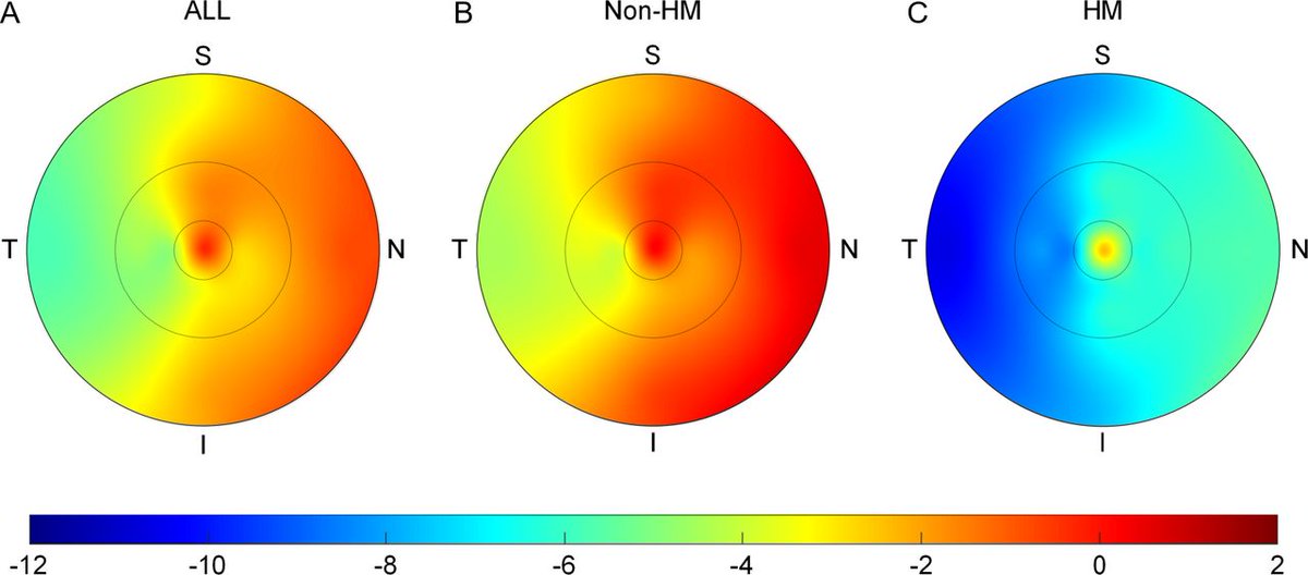 In adolescents, eyes with high myopia exhibit a more significant decrease in #macular choroidal thickness than those without high myopia. Peripapillary atrophy area may be used to predict potential #myopia progression in adults: bit.ly/3vz0aYc #retina #vision #eyes