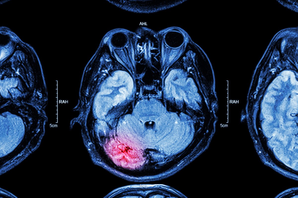 Bolstered by early funding from BrightFocus, a promising new treatment for individuals suffering from stroke, concussion, and traumatic brain injury—known risk factors for dementia—has received approval from the @FDA to move into Phase 2 clinical trials. bit.ly/4aBF4Hl