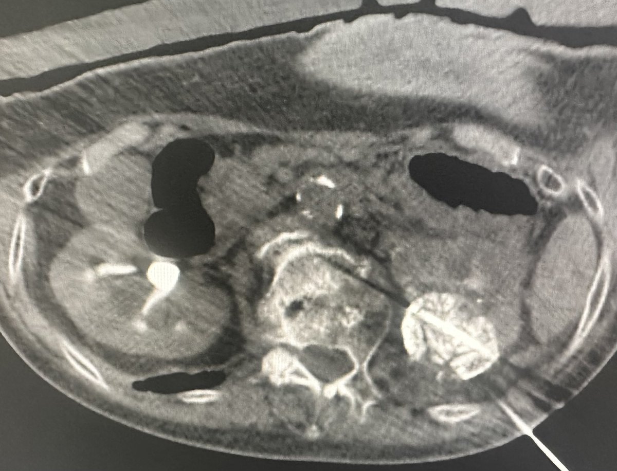 Same session outpatient #EmboCryo for T1b RCC (kidney cancer) in a non-surgical patient. Becoming routine for these high risk operative patients. #iRad