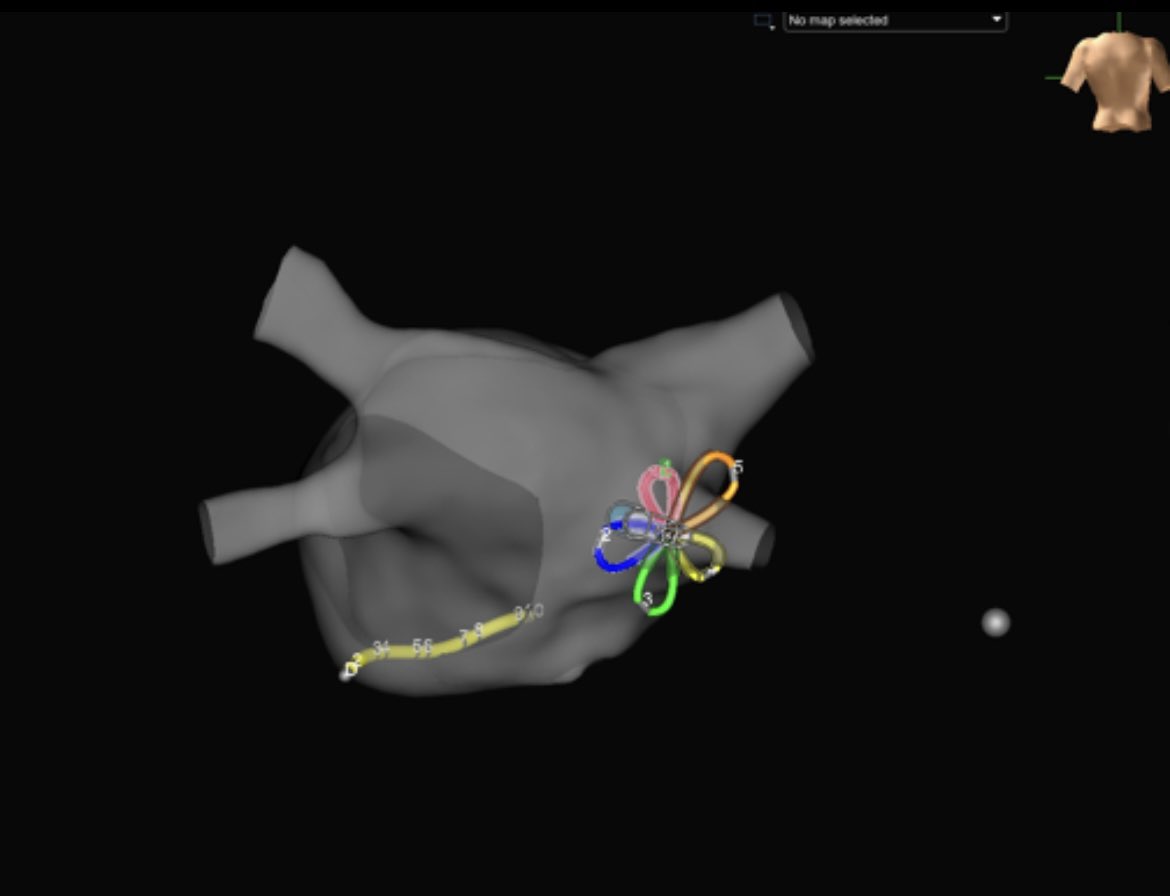 Let our maps and catheter visualization guide your PFA delivery, so fluoro doesn’t have to #PFAonX #MappingMatters #AbbottProud