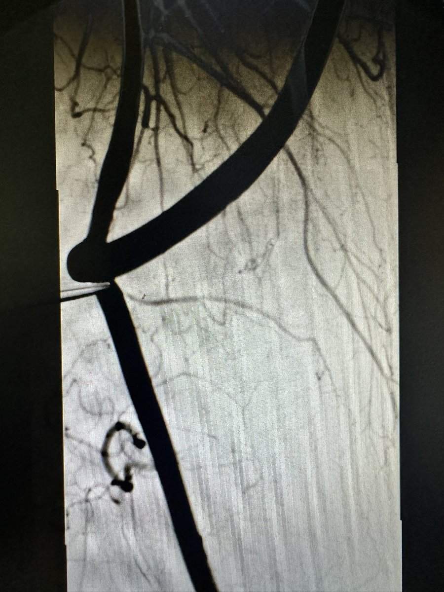 Have you ever had an #ESKD patient with an (for >3 days) occluded #HeRO graft, who had traveled from Afrika for you to revise it? 😳 (spoiler alert: case done 😎) #VascularAccessCenter #Hamburg