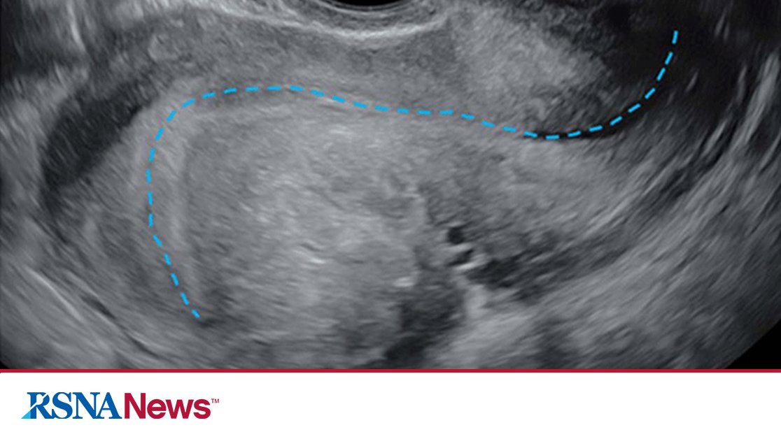 #RT RSNA: A new Society of Radiologists in Ultrasound (SRU) expert consensus statement to improve endometriosis evaluation was published in the journal Radiology. bit.ly/4aNuxJ0 @ScottWYoungMD  #Radiology