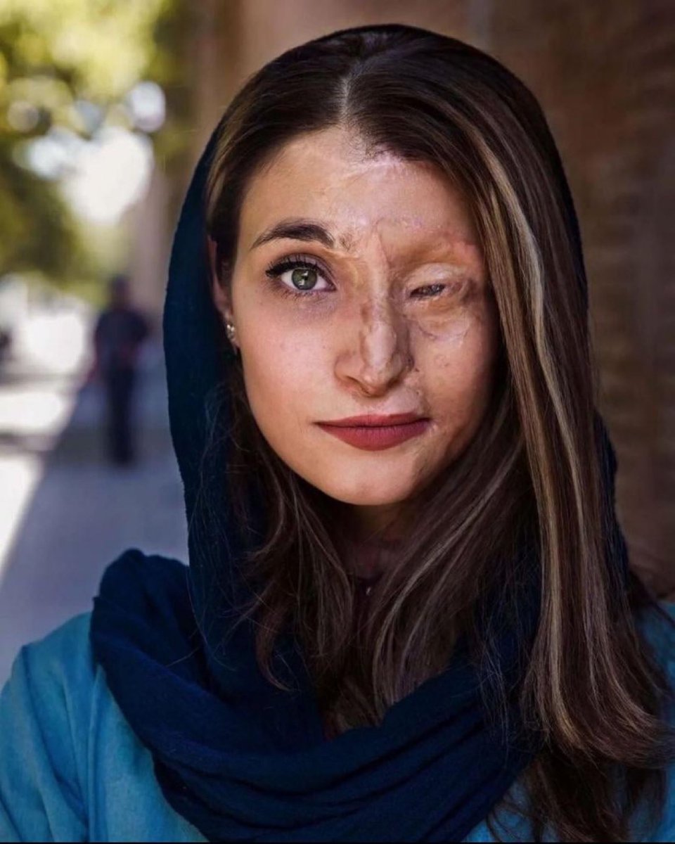 Marzieh Ebrahimi è una coraggiosa donna iraniana, che è stata aggredita con l'acido perché non indossava l'hijab per strada. Questo è il rispetto che hanno per le donne nei paesi islamici. Ma non vedrete le femministe sinistrate rivendicare i loro diritti in questi paesi.