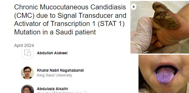 STAT 1 GOF mutation in an 8-year-old Saudi female
       * tweeted by Shira *
researchgate.net/publication/37… #immunology #raredisease