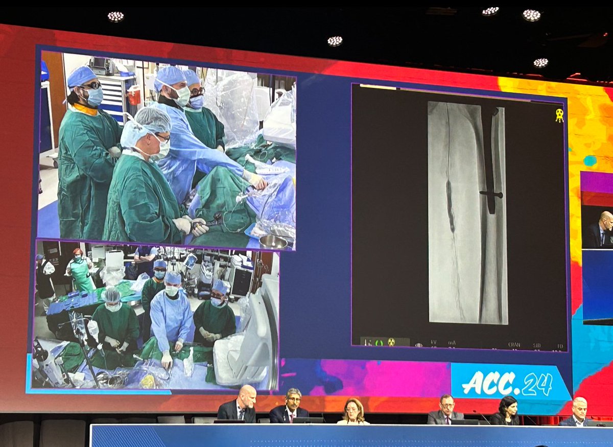 Sunday at #ACC24, Drs. Khusrow Niazi & @Psandesara_MD performed a live case with #ShockwaveIVL. A severely calcified SFA was treated with 300 pulses of #ShockwaveM5Plus and followed with a DCB. Everyone on the panel agreed that #PeripheralIVL would be the best tool for this case,…