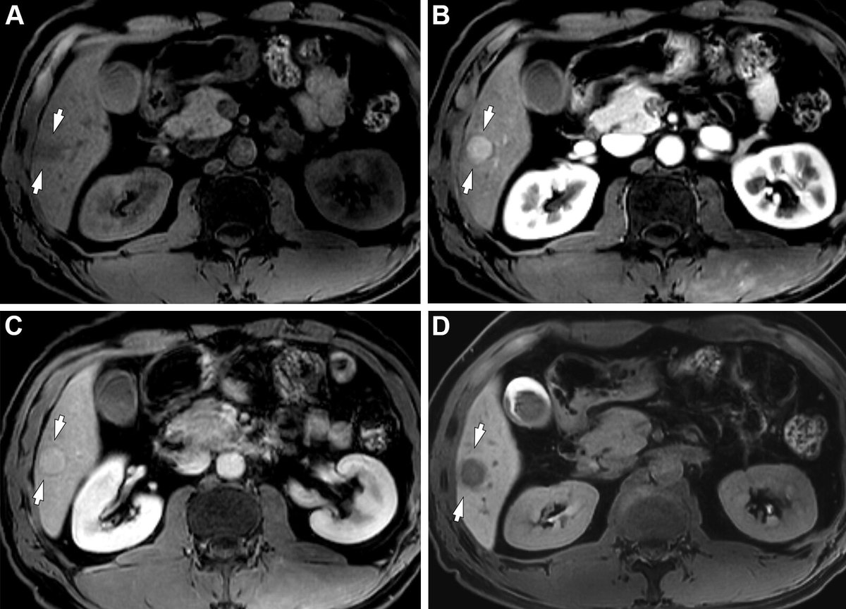 Eastern HCC diagnostic guidelines offered higher sensitivity, whereas Western guidelines provided higher specificity in patients with cirrhosis and in those with chronic hepatitis B. bit.ly/4avuX6W