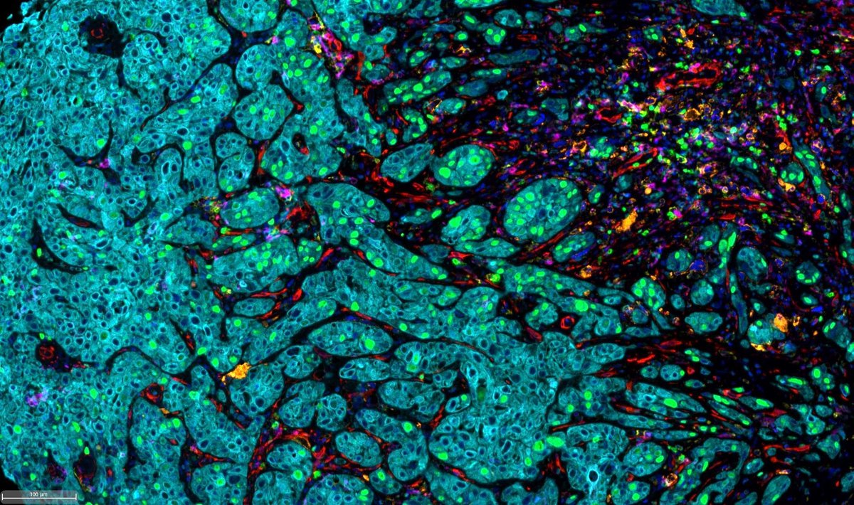 This week’s #MGRIimageoftheweek is A Living Puzzle by @druiztorres_ from @MGHCancerCenter! This image shows a tumor biopsy from a patient diagnosed with head and neck cancer. Read more: mgriblog.org/2023/11/13/vot… @svploeg