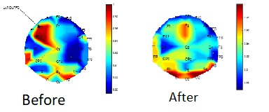 dorianaur's tweet photo. @TuckerCarlson @bryan_johnson @elonmusk When the stimulation targets the location of  brain dysfunction it facilitates brain self-healing in a manner akin to  how a hydrogel patch aids in healing injured skin #mentalhealth
@elonmusk @TuckerCarlson @bryan_johnson https://t.co/lKt7s5iBE9