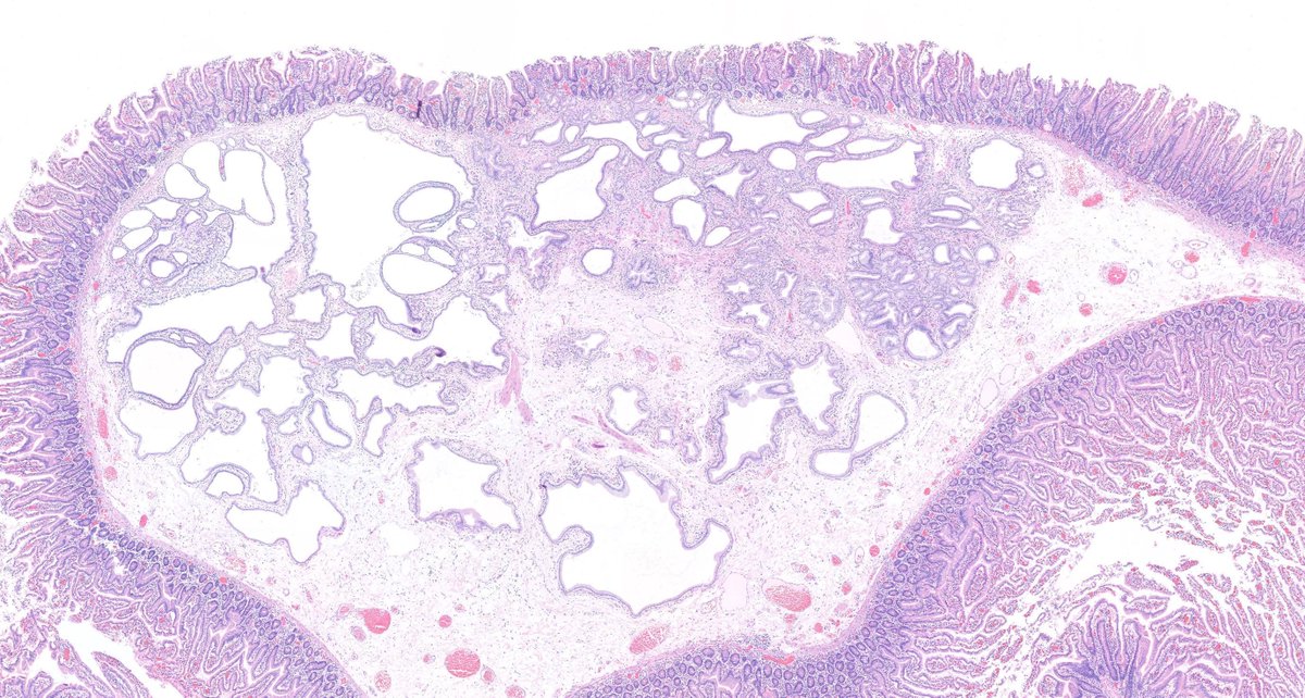 Pancreatic heterotopia in duodenum. #GIpath